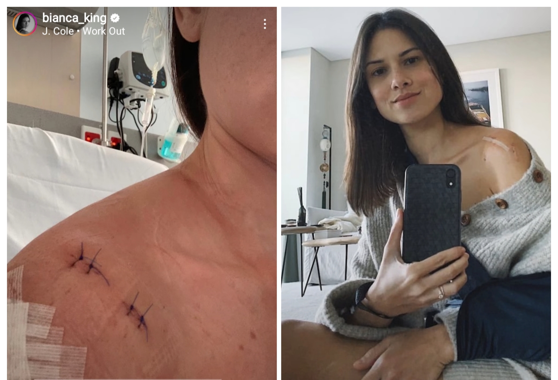 Bianca King na-misdiagnose sa isang ospital sa Pinas; nagpa-surgery ng balikat sa ibang bansa