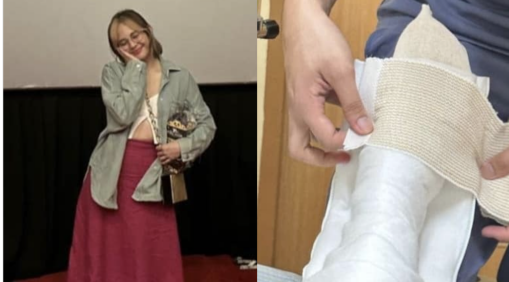 Janella Salvador nagkaroong muli ng ankle injury: Just a clumsy not so little girl