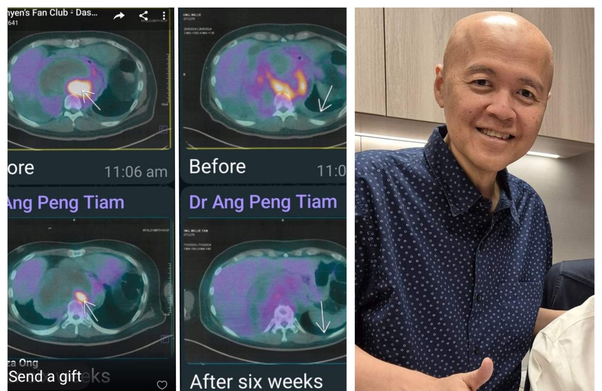 May himala! Sarcoma cancer ni Doc Willie gumagaling, bukol biglang lumiit