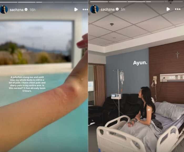 Sachzna Laparan sinugod sa ospital dahil sa jellyfish: ‘Photoshoot gone wrong!’